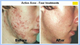 Photodynamic Therapy | Norseld Lasers